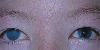 Most common signs & symptoms in MPS 1 patients